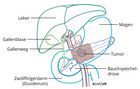 Resektionsausmass bei Tumor im Pankreaskorpus (Mittelsegment)